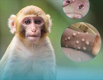 Bệnh nhân đầu tiên mắc đậu mùa khỉ tại Việt Nam là nữ, khởi phát bệnh khi đang đi du lịch