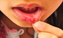 Bị tưa miệng, nhiệt miệng chữa thế nào?