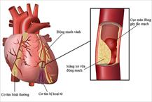 Viêm cơ tim có nguy hiểm không, biểu hiện của viêm cơ tim