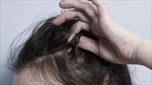 Thuốc trị bệnh Alzheimer có thể làm giảm chứng rối loạn giật tóc