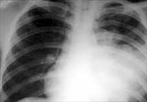 Bệnh viêm thùy phổi ở trẻ em biến chứng nguy hiểm khó lường