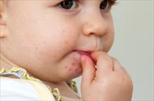 Đã xác định kiểu gene của Enterovirus 71 gây bệnh tay chân miệng nặng ở trẻ em