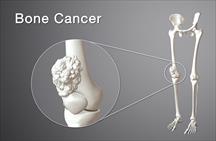 Dấu hiệu dễ nhận thấy của ung thư xương