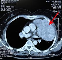 Khám ruột thừa bất ngờ phát hiện ung thư phổi