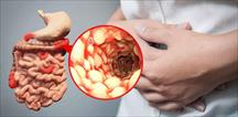 Bệnh Crohn có biểu hiện và những hệ lụy gì?