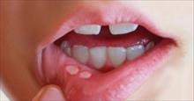 Làm gì khi trẻ bị viêm loét miệng?