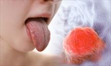 Ung thư lưỡi dễ nhầm với nốt nhiệt miệng, nhận biết thế nào?