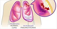 Tràn khí màng phổi ở những người hút thuốc lá