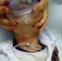 Bé trai 6 tuổi suy hô hấp cấp suýt chết vì bị dây nhựa thít chặt cổ