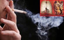 Chuyên gia cảnh báo nguy cơ mắc ung thư phổi do tiếp xúc với khói thuốc lá thụ động
