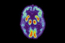 Trí tuệ nhân tạo phát hiện Alzheimer trong các bản chụp cắt lớp não sớm 6 năm so với chẩn đoán
