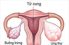 Bác sĩ Lê Thị Thu Sương: 'Ung thư buồng trứng có thể xảy ra ở mọi phụ nữ'