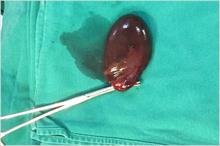 Đau dữ dội vùng bụng trên rốn, bệnh nhân phải cắt túi mật vì bệnh cảnh hiếm gặp
