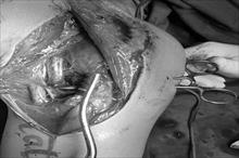 Nối dây thần kinh vai bị chém đứt cho nam bệnh nhân 20 tuổi nhờ kỹ thuật vi phẫu
