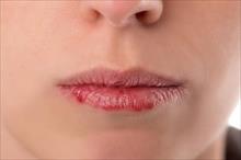 Bị ngứa rát ở vành môi: Nguyên nhân và cách khắc phục