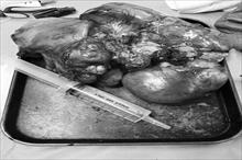 Phẫu thuật thành công khối u trung thất đến 4 kg