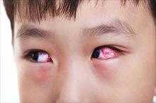 Có thể mù nếu đau mắt đỏ mà dùng các loại thuốc này