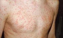 Các bệnh ngoài da do virus thường gặp và cách điều trị