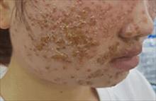 Tổn thương da sau hai lần rửa mặt bằng loại bột lạ