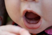 Xử trí khi răng sữa của trẻ bị đen