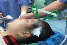 Bé gái ở Nghệ An bị kéo nhọn găm sâu 3cm vào đầu