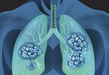 Công bố kết quả nghiên cứu về hoạt chất Lunasin chiết xuất từ Soy Protein hỗ trợ điều trị ung thư phổi