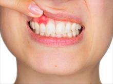 Ung thư lợi dễ nhầm đau răng