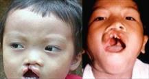 Gần 40.000 trẻ em Việt Nam ra đời mỗi năm bị dị tật bẩm sinh